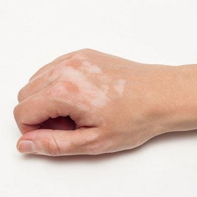 Benoquin (Monobenzone 20%) Cream: How It Works and When It’s Used 5 image 1