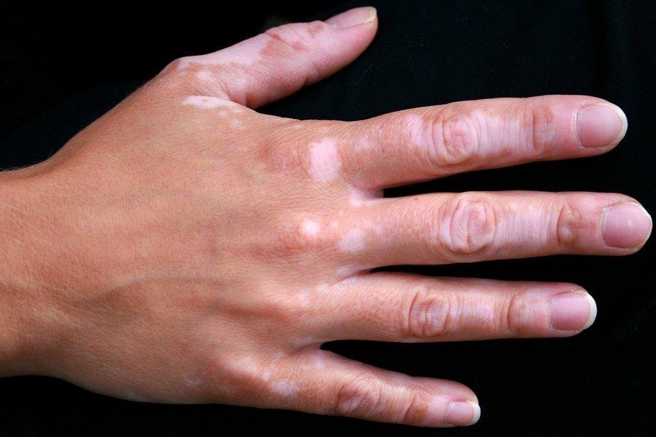 Benoquin (Monobenzone 20%) Cream: How It Works and When It’s Used 2 image 4