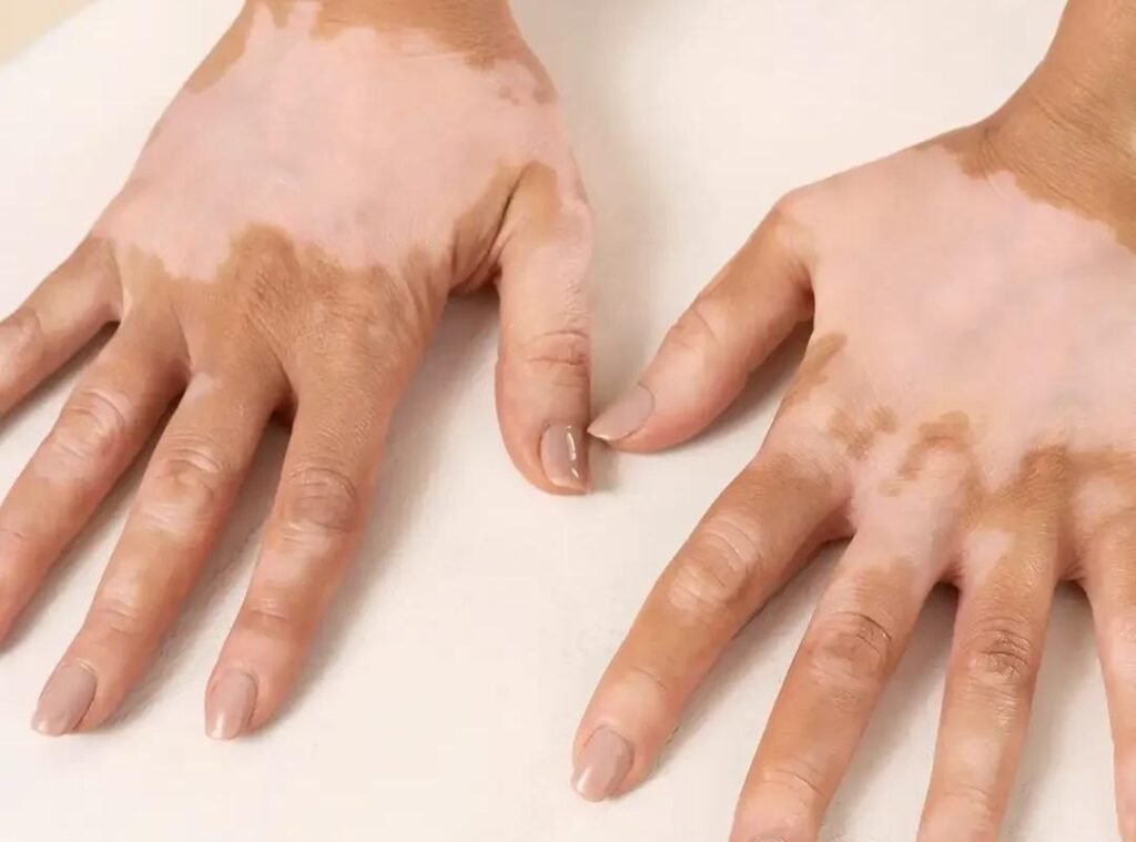Benoquin (Monobenzone 20%) Cream: How It Works and When It’s Used 4 image 5
