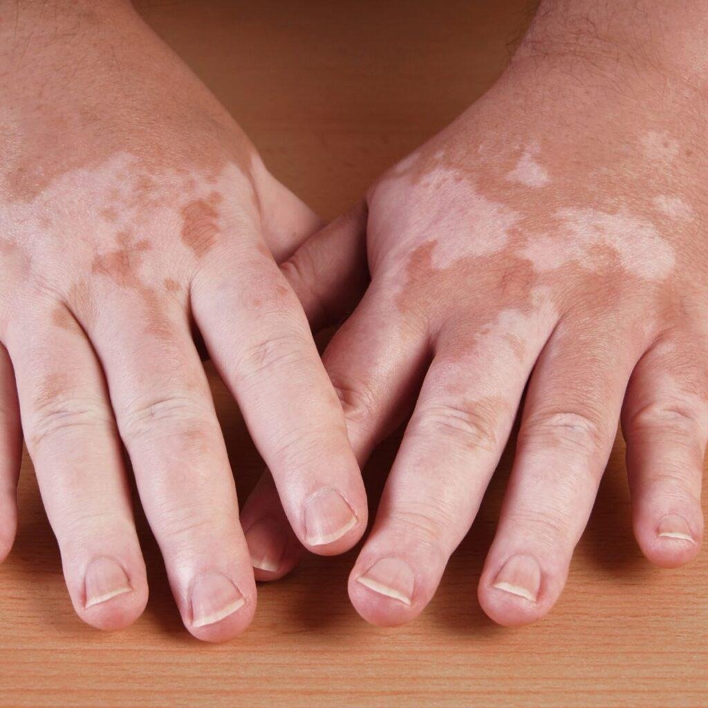 Benoquin (Monobenzone 20%) Cream: How It Works and When It’s Used 3 image 7