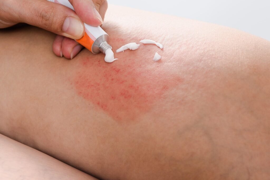Benoquin (Monobenzone 20%) Cream: How It Works and When It’s Used 8 image 9